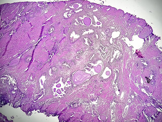 Photomicrograph,  prostatitis (CP), a common condition that causes inflammation of the prostate...