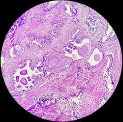 Photomicrograph,  prostatitis (CP), a common condition that causes inflammation of the prostate...