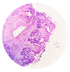 Photomicrograph of Gastric biopsy showing Grade 3 adenocarcinoma