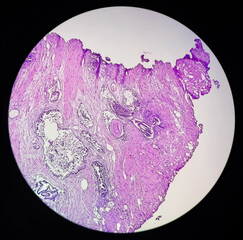 Photomicrograph,  prostatitis (CP), a common condition that causes inflammation of the prostate...
