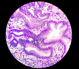 Photomicrograph of Gastric biopsy showing Grade 3 adenocarcinoma