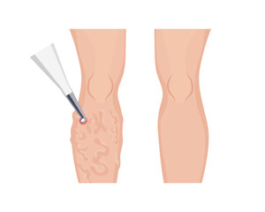 Laser treatment removing varicose veins on patient's leg