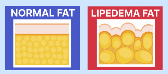 Normal fat VS lipedema fat. Medical illustration. Vector illustration. 