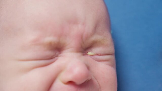 Baby eyes with eye mucus in selective focus. Disease tear ducts tons of newborns close up. Nasolacrimal duct obstruction in baby it is a blockage of the lacrimal drainage system. 