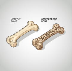 Healthy Bones and Weak Osteoporosis Vector Illustration. 