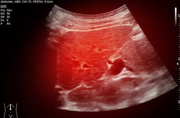 A normal ultrasound of the upper abdomen, showing healthy organs with no abnormalities. Clear imaging of the liver, pancreas, and surrounding structures.