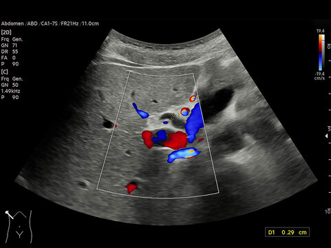 A normal ultrasound of the upper abdomen, showing healthy organs with no abnormalities. Clear imaging of the liver, pancreas, and surrounding structures.