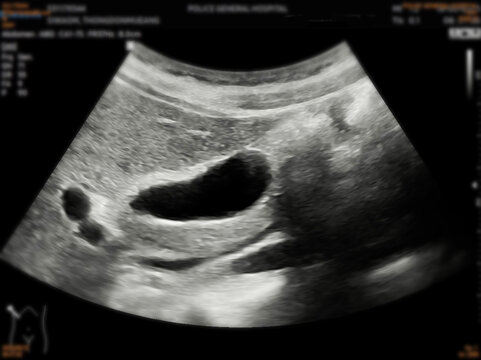 A normal ultrasound of the upper abdomen, showing healthy organs with no abnormalities. Clear imaging of the liver, pancreas, and surrounding structures.