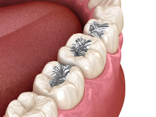Amalgam restoration. Medically accurate 3D animation of dental concept