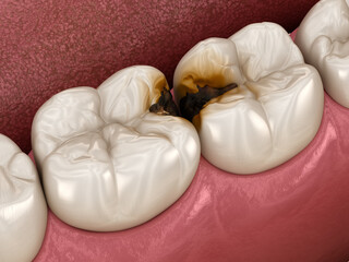 Molar teeth damaged by caries. Dental 3D illustration
