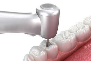 Making access to the root canal. 3D illustration