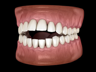Openbite dental occlusion ( Malocclusion of teeth ). 3D illustration