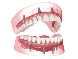 Dental prosthesis based on 4 implants. Dental 3D illustration