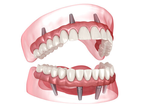 Dental prosthesis based on 4 implants. Dental 3D illustration