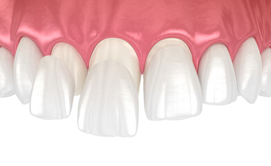 Dental veneers on blue background. 3D illustration