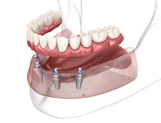 Dental prosthesis based on 4 implants. Dental 3D illustration
