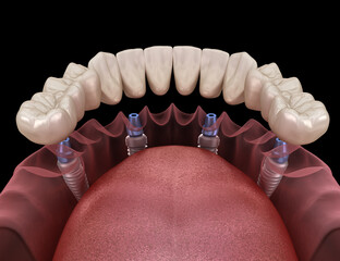 Dental prosthesis based on 4 implants. Dental 3D illustration