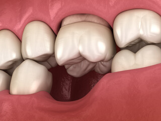 Teeth shift deformatiuon after losing molar tooth. 3D illustration