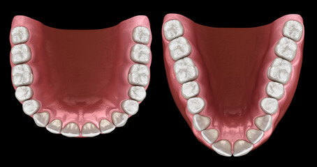 U-shape and V-shape tapered arch form of maxilla. 3D illustration © Alex Mit