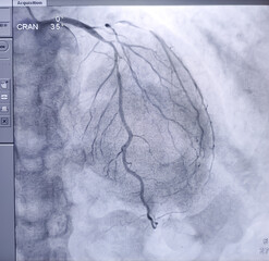 Coronary angiogram of left coronary artery during cardiac catheterization with contrast dye. Abnormal findings. Colour adjust.
