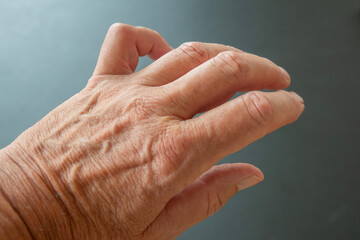 Hand of a person with Dupuytren's contracture - a condition in which one or more fingers become permanently bent in a flexed position. Here the little finger, causing it to bend towards the palm.