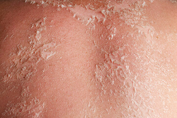 Sunburn on the skin. Skin from the burn texture. Dry skin in need of treatment and hydration. Close up
