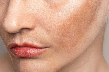 Womans face with pigmentation, melasma, freckles, age spots photo. Close up photo texture
