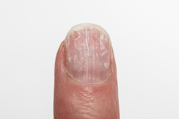 Close-up of a damaged fingernail with peeling and brittle surface on a white background. Concept of nail health, injury, and care. Mechanical nail damage. bad habits. nail health on hormonal balance