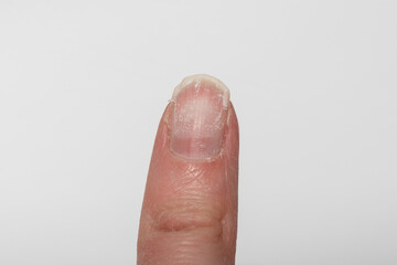 Close-up of a damaged fingernail with peeling and brittle surface on a white background. negative impact of stress on nail health. harmful effects of household chemicals. Fungal nail infections
