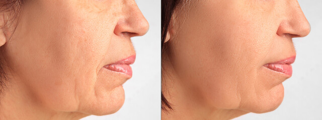 Obraz premium Ageing. Photos of woman's face, closeup of lower part. Collage showing difference in skin texture