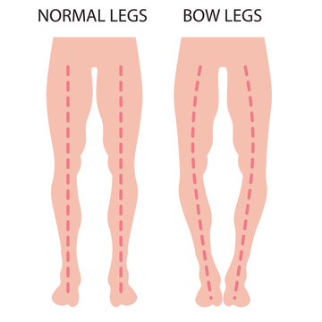 Flat vector illustration of bow legs and knock knees in children and young people, showing symptoms like leg curvature and posture issues, with similarities to rickets and Blount&rsquo;s disease.