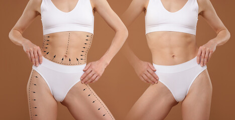 Liposuction, collage. Woman with perfect figure against pale brown background, closeup. Markings on her body