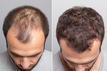 Before and after comparison of a man with hair loss and successful hair restoration. Hair growth treatment concept.