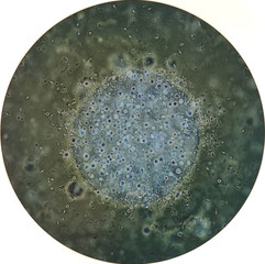 Microscopic examination of semen showing Asthenozoospermia with plenty of RBC. Blood in semen or Hematospermia with reduce motility.