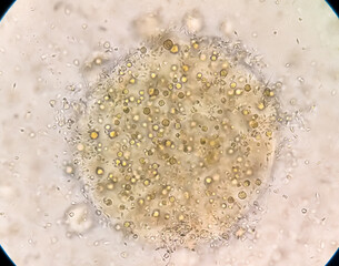 Microscopic examination of semen showing Asthenozoospermia with plenty of RBC. Blood in semen or Hematospermia with reduce motility.