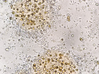 Microscopic examination of semen showing Asthenozoospermia with plenty of RBC. Blood in semen or Hematospermia with reduce motility.
