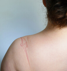 A woman with a clothing mark on her back. A close-up of a woman's back with a red mark from a strap...