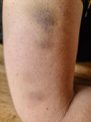 Large bruise showing on upper arm skin