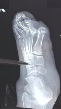 Vertical footage of doctor learn Medical X-ray with leg toe dislocations. Hook-shaped deformity of the finger. Lis franc joint, Foot fractures. 4k footage.