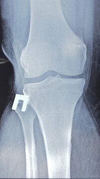 Vertical video of doctor learning X-ray of Knee joint dislocation after accident. Patellar joint instability. Tibial dislocation in relation to the femur. 4k footage.