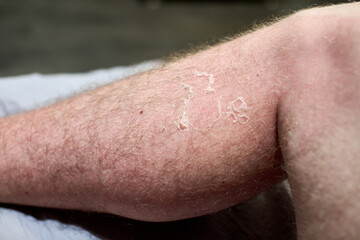 Naklejka premium Close-up of arm shows peeling skin due to sunburn. Indoor lighting highlights texture and redness. Background slightly blurred, focus on peeling area