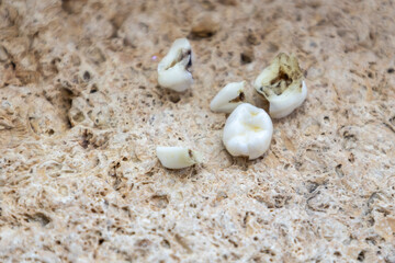 Five extracted baby teeth lie on a stone background. 5 decayed baby teeth affected by caries.