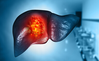 Liver cancer or liver tumor, Hepatocellular carcinoma (HCC), causes, symptoms, treatments, 3d illustration