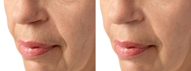 Ageing. Photos of woman's face, closeup of lower part. Collage showing difference in skin texture