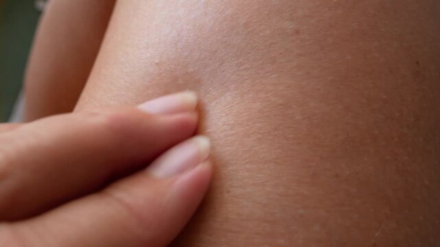 mosquito bites ticks on woman's legs, big red spots on skin, Lyme disease,  closeup