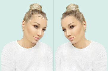 Thinning hair and hair loss,female pattern baldness,Hair transplant