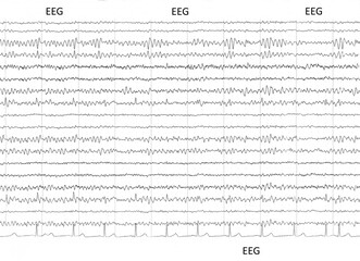 Aufzeichnung eines EEG - neurologische Untersuchung