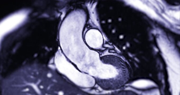 MRI heart stress test revealing detailed cardiac function under controlled conditions, aiding in early diagnosis and High-resolution imaging captures heart performance during stress.