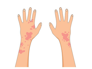 Hand with psoriasis wounds, psoriasis skin rash