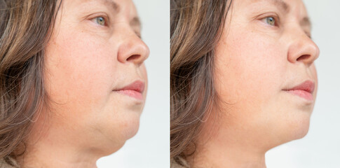 Woman before and after cosmetic treatment, double chin removal, sagging skin care, realistic aging, facial lift, closeup face profile, mature beauty, Anti-aging result comparison